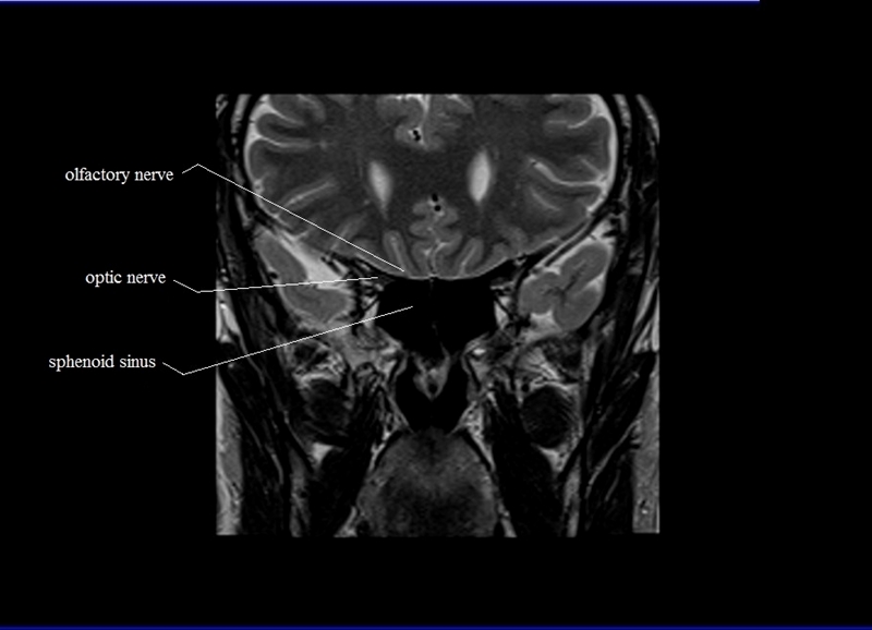MRI anatomy brain axial image 16