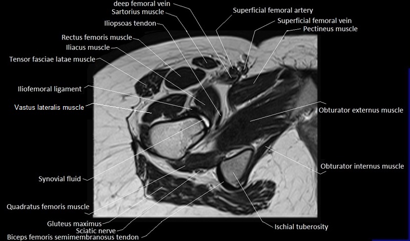 mri axial cross sectional anatomy hip 17