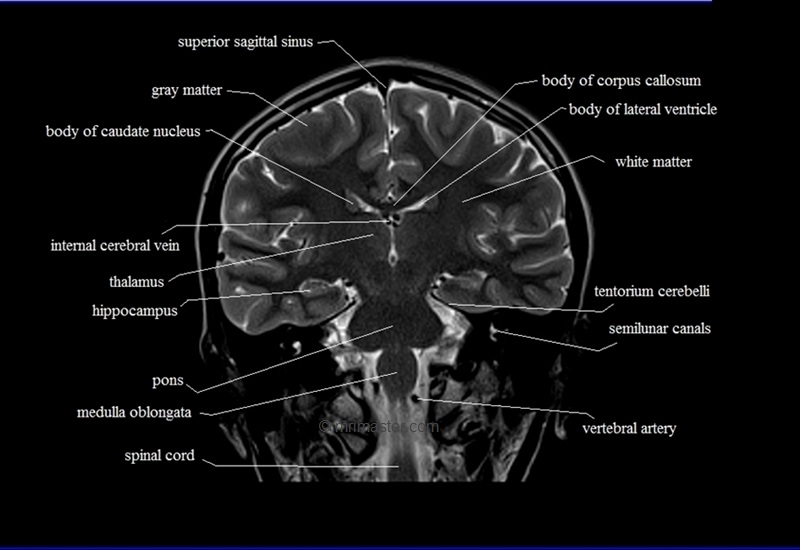 MRI anatomy brain axial image 17