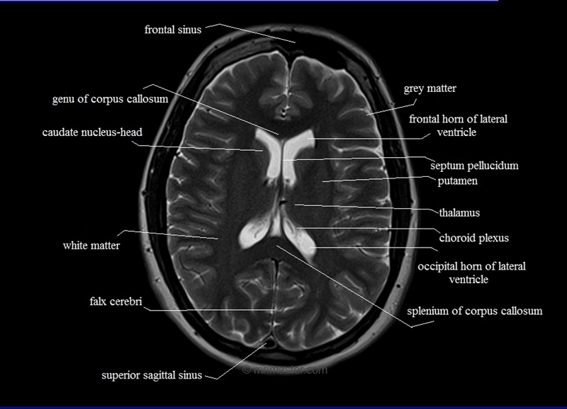 mri brain anatomy