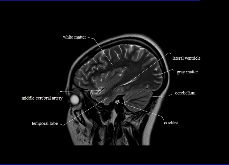MRI anatomy brain axial image 18