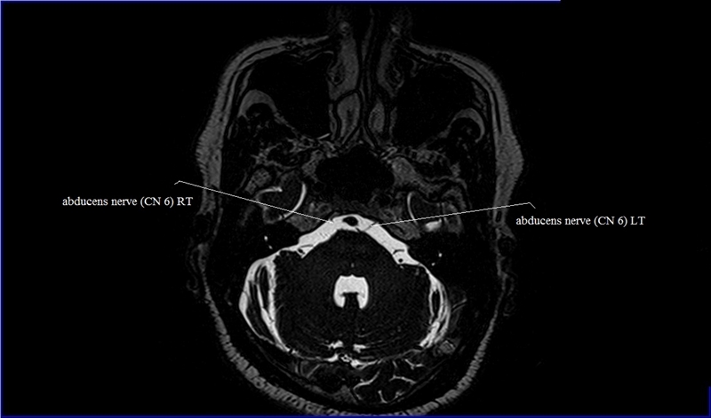 MRI anatomy brain axial image 18