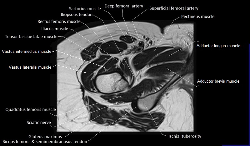 mri axial cross sectional anatomy hip 19