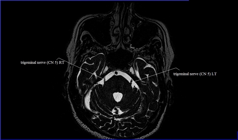 MRI anatomy brain axial image 19