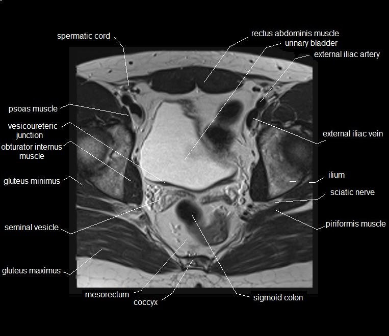 mri axial cross sectional anatomy male pelvis 19
