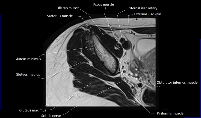 mri axial cross sectional anatomy hip 2