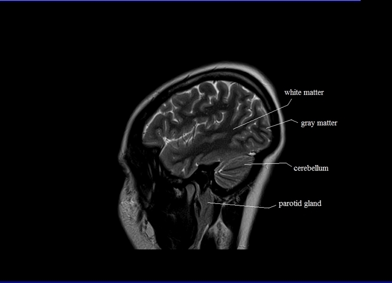 MRI anatomy brain axial image 20