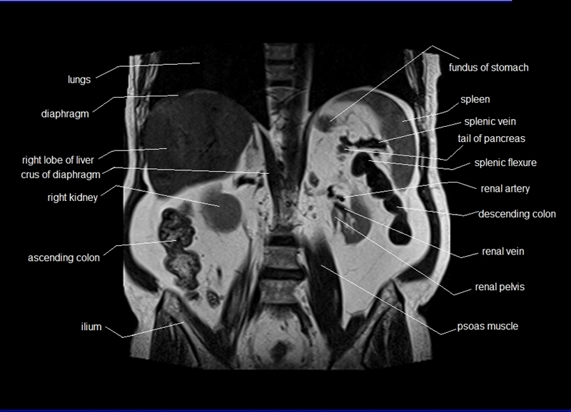 mri coronal cross sectional anatomy of abdomen image 20