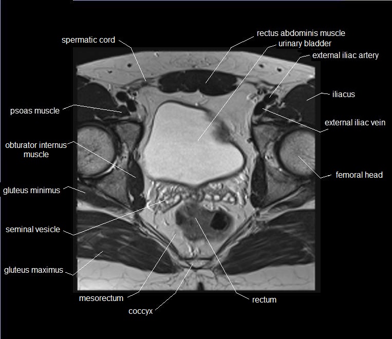 mri axial cross sectional anatomy male pelvis 21