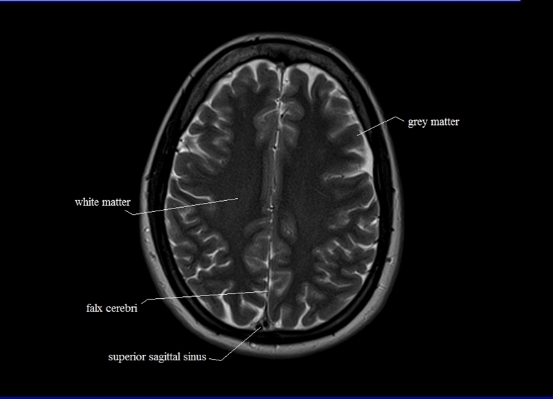 mri brain anatomy