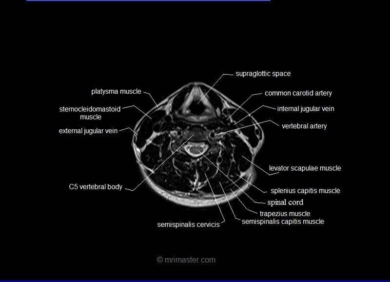 mri neck axial cross sectional anatomy image 1