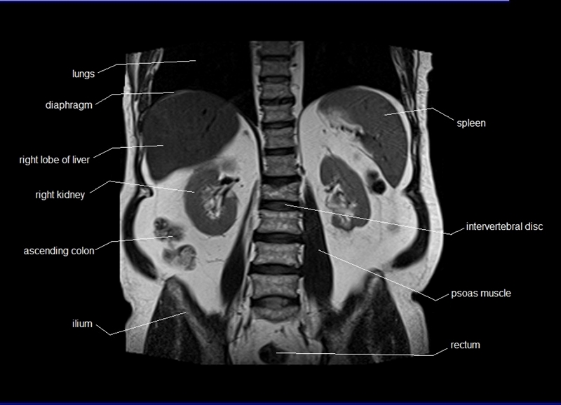 mri coronal cross sectional anatomy of abdomen image 22