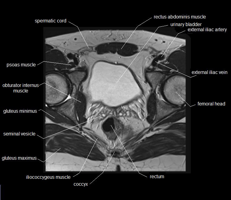 mri axial cross sectional anatomy male pelvis 22