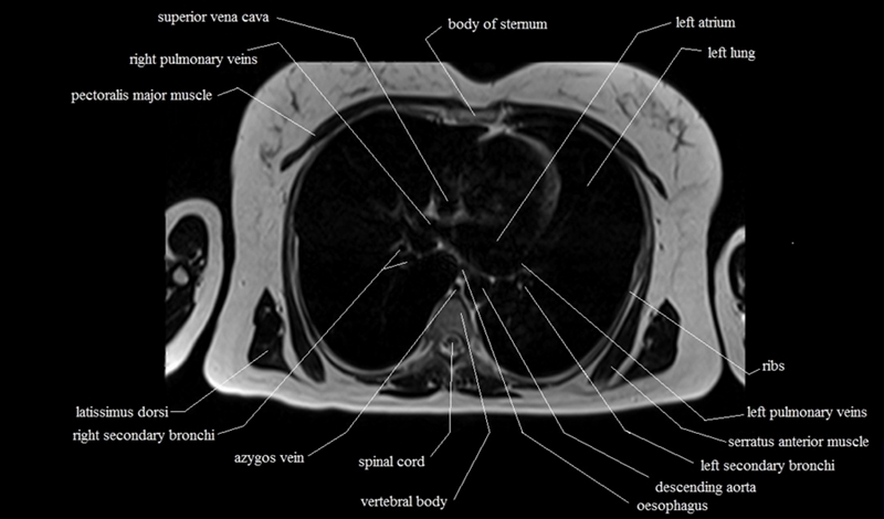 mri cross sectional anatomy chest (thorax) axial