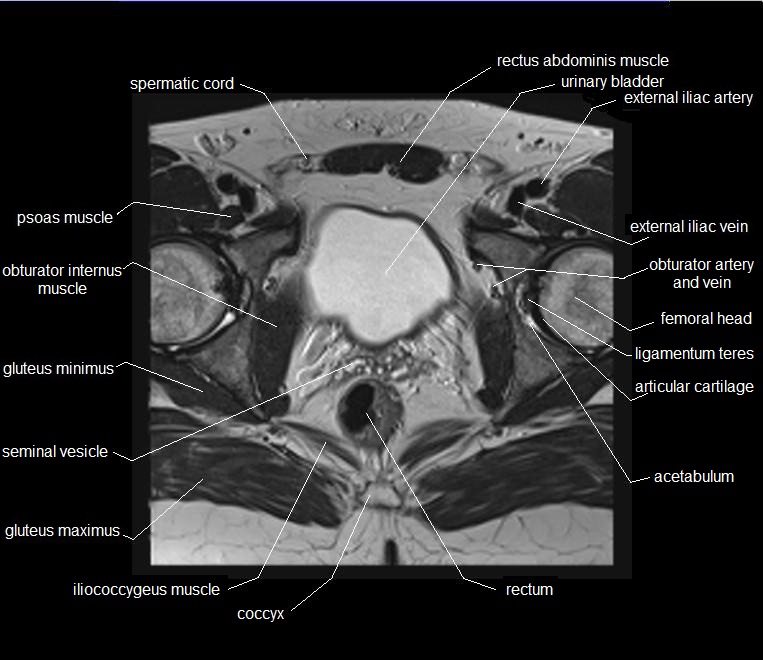 mri axial cross sectional anatomy male pelvis 23