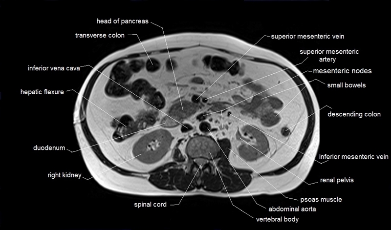 mri axial cross sectional anatomy of abdomen image 24