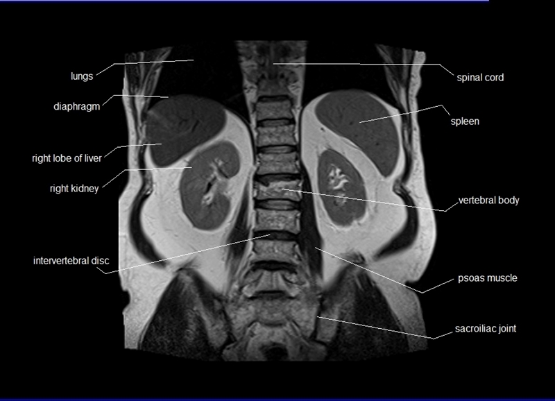 mri coronal cross sectional anatomy of abdomen image 24