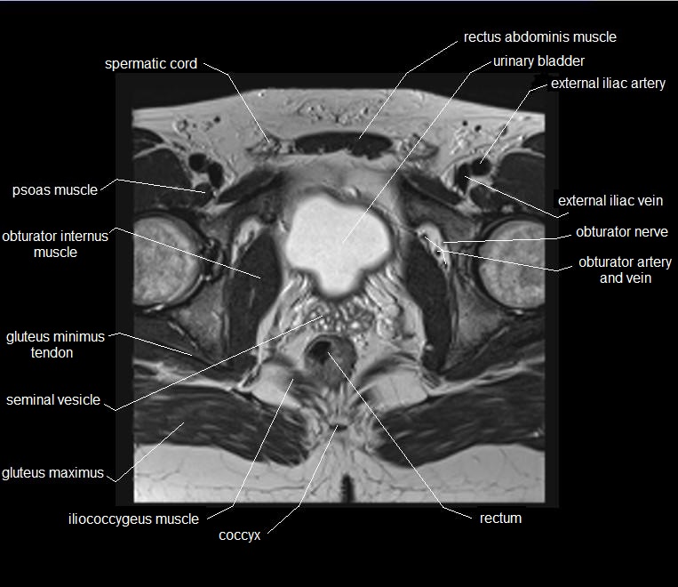 mri axial cross sectional anatomy male pelvis 24