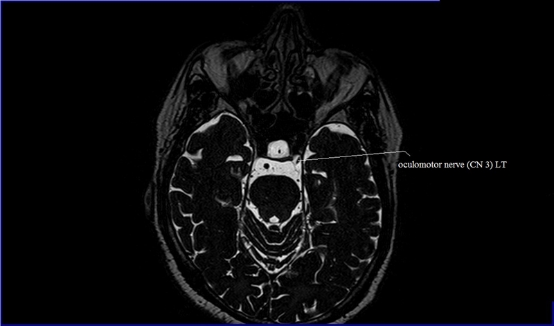 MRI anatomy brain axial image 25