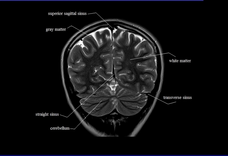 MRI anatomy brain axial image 26