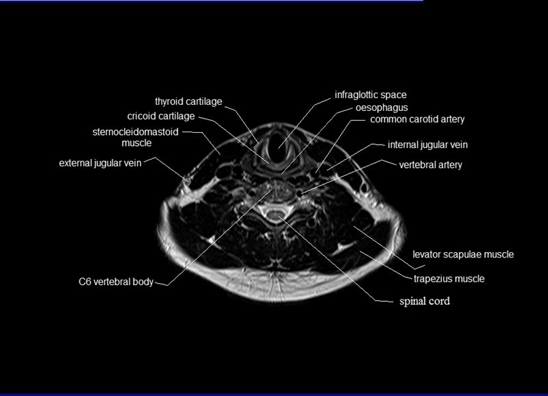 MRI Neck Anatomy Free MRI Axial Neck Cross Sectional Anatomy MRI Neck Anatomy Free MRI Axial Neck Cross Sectional Anatomy