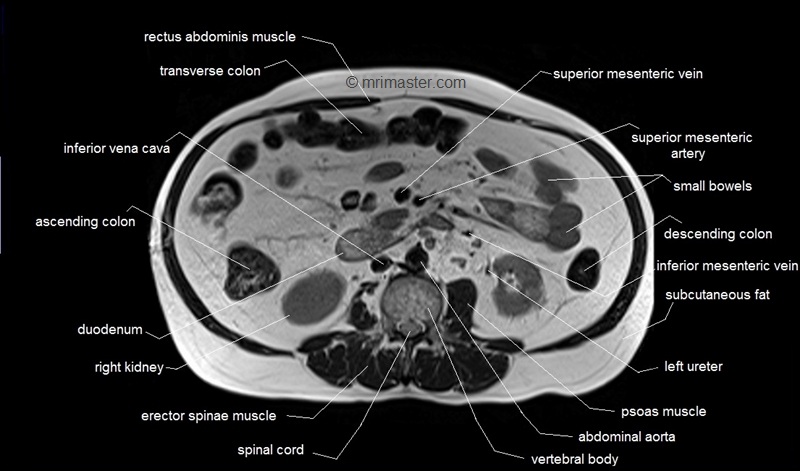 mri axial cross sectional anatomy of abdomen image 26