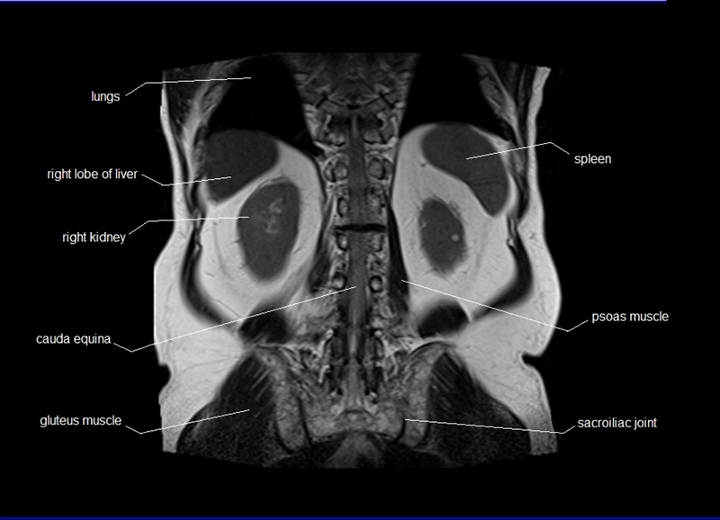 mri coronal cross sectional anatomy of abdomen image 26
