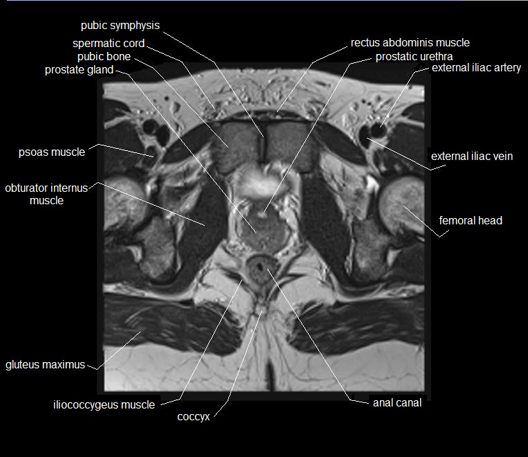 mri axial cross sectional anatomy male pelvis 26