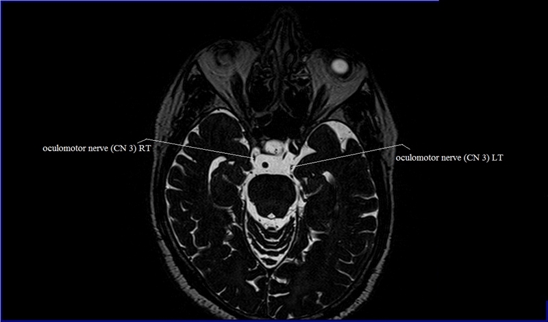 MRI anatomy brain axial image 27