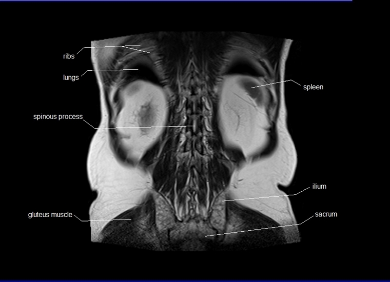 mri coronal cross sectional anatomy of abdomen image 28