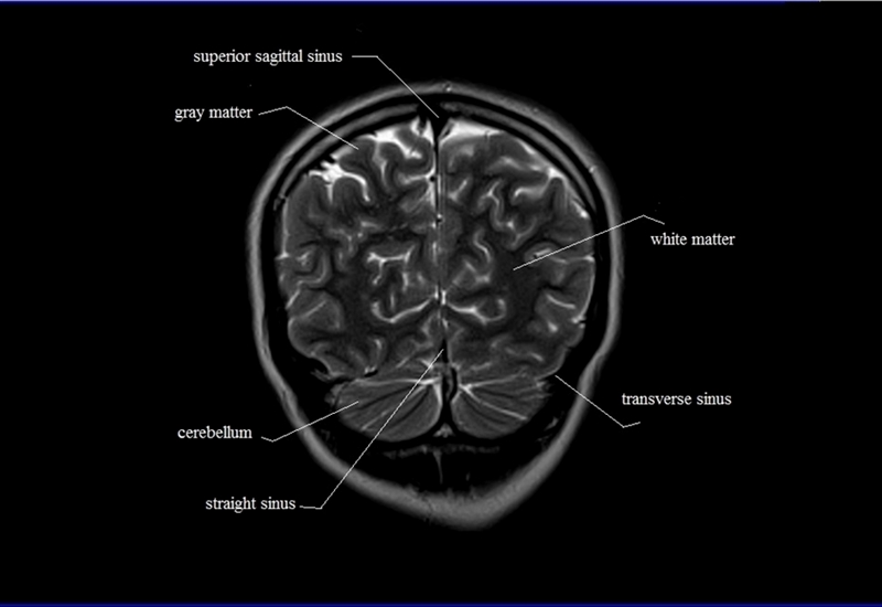 MRI anatomy brain axial image 28