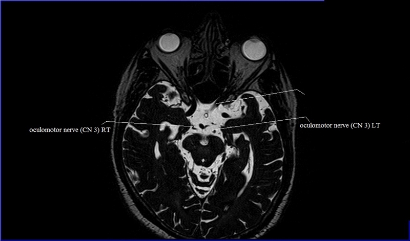 MRI anatomy brain axial image 29
