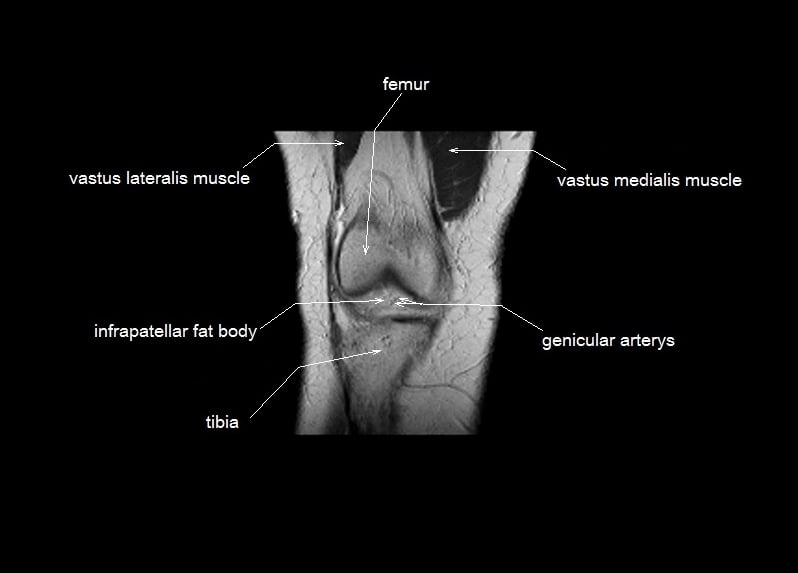 mri coronal cross sectional anatomy knee 3