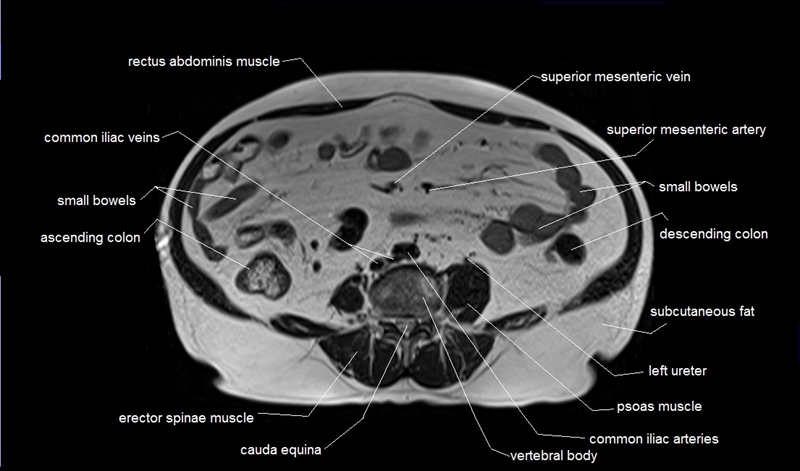 mri axial cross sectional anatomy of abdomen image 32