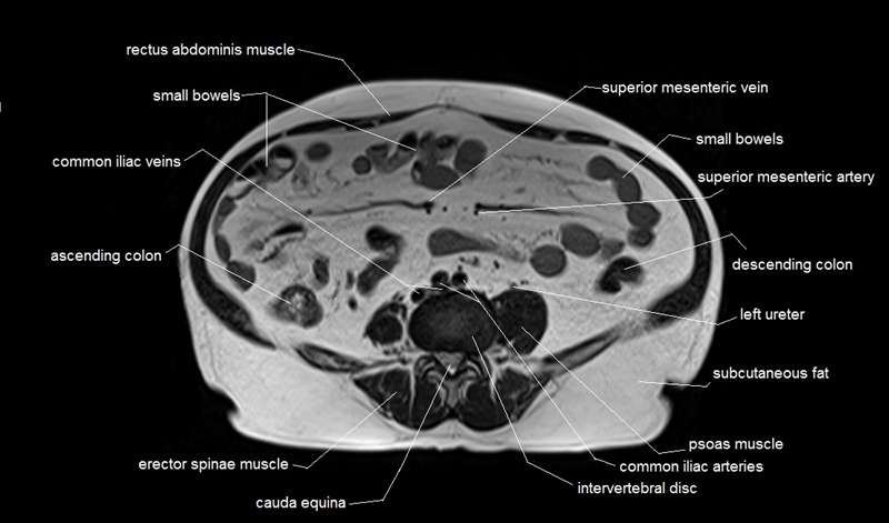 mri axial cross sectional anatomy of abdomen image 33
