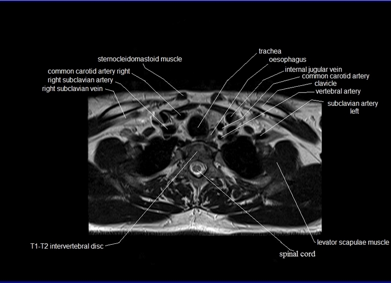 mri neck axial cross sectional anatomy image 35