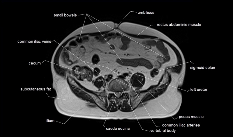 mri axial cross sectional anatomy of abdomen image 37