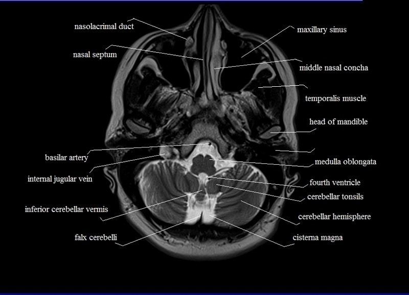 MRI anatomy brain axial image 4