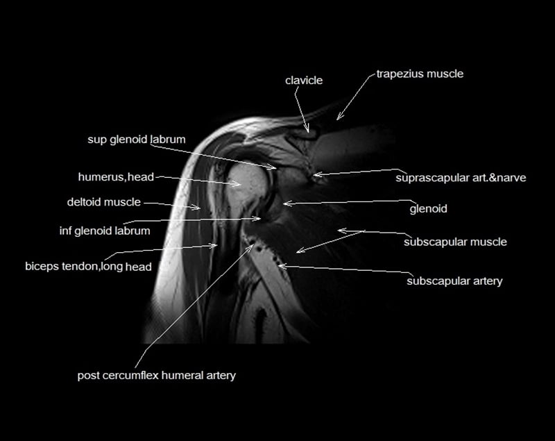 mri shoulder cross sectional anatomy coronal image 4
