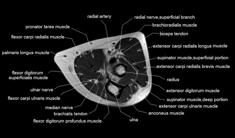 MRI Anatomy of Elbow | Axial Cross Sectional Anatomy of Elbow Joint