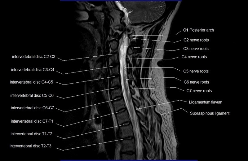 mri cervical spine sagittal cross sectional anatomy image 4