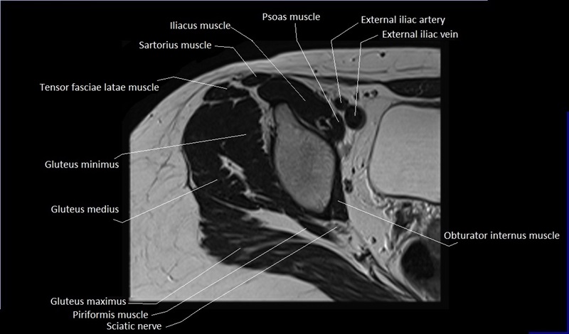 mri axial cross sectional anatomy hip 5