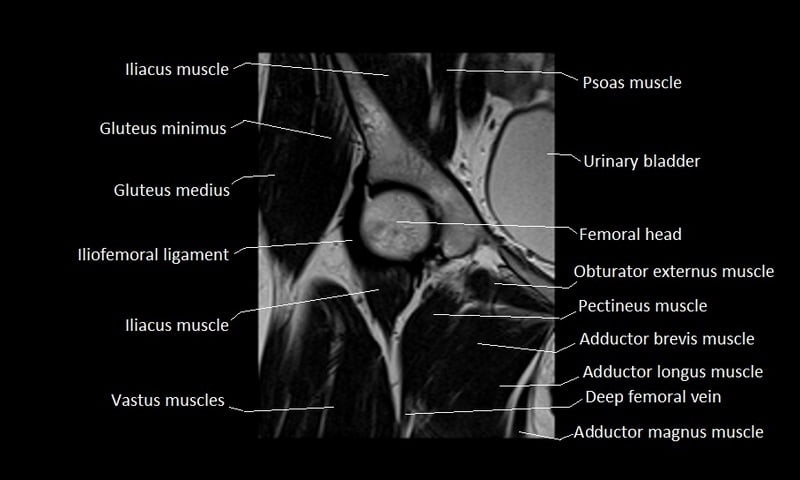 mri coronal cross sectional anatomy hip 5
