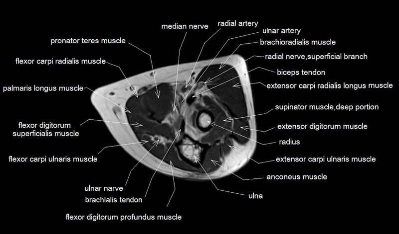 Mri Anatomy Of Elbow Axial Cross Sectional Anatomy Of Elbow Joint