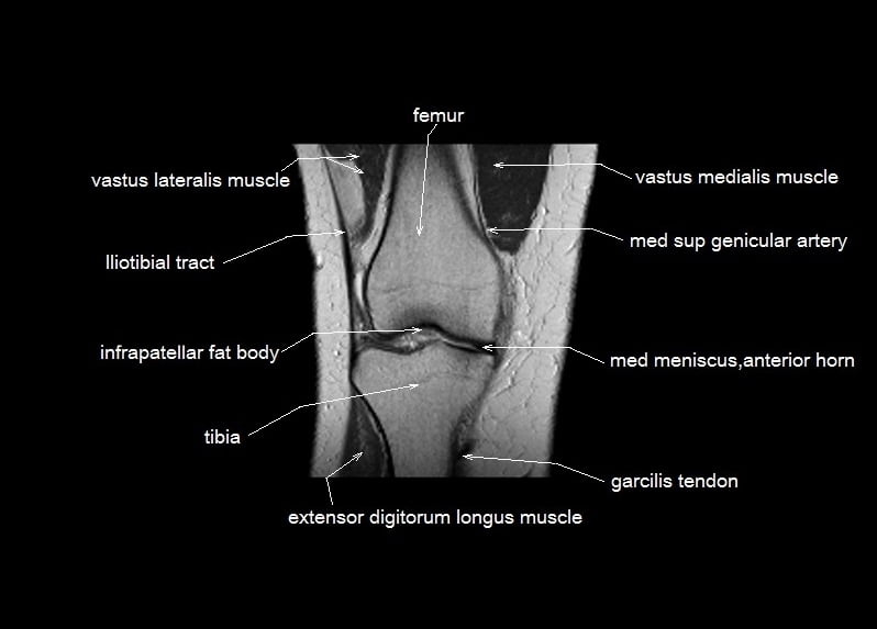 mri coronal cross sectional anatomy knee 5