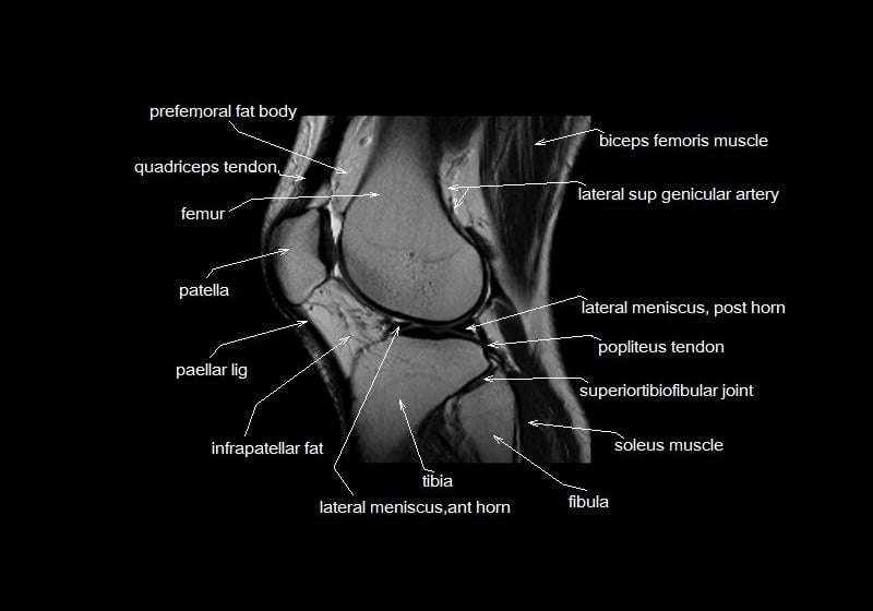 Mri Knee Coronal