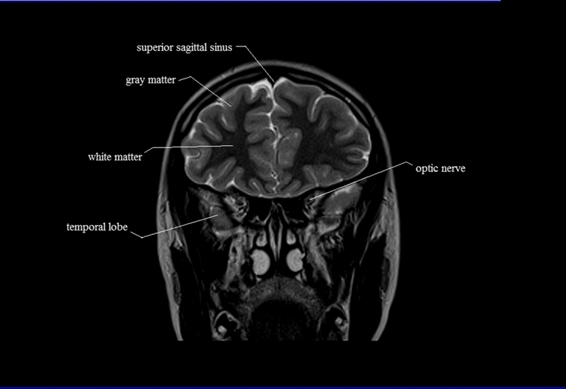 MRI anatomy brain axial image 5