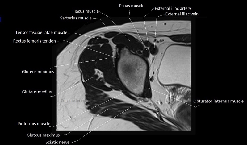mri axial cross sectional anatomy hip 6