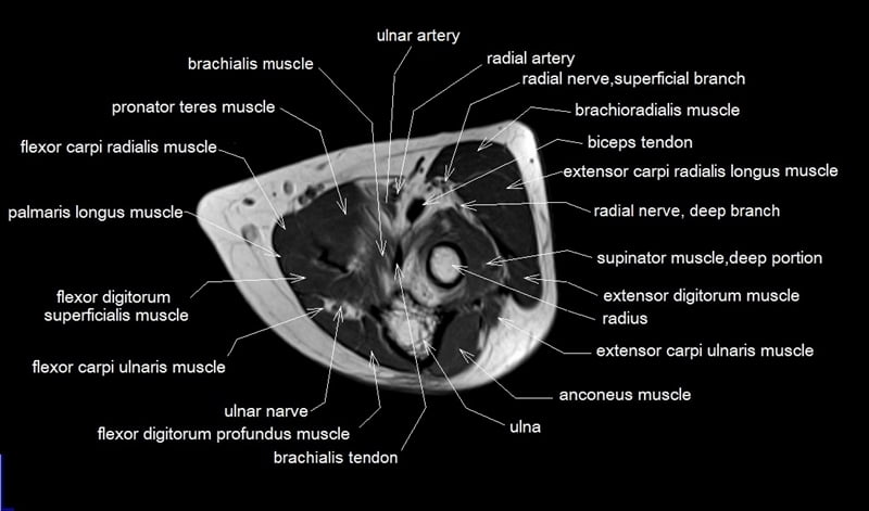 mri axial cross sectional anatomy elbow joint image 6