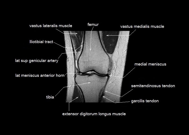 mri coronal cross sectional anatomy knee 6